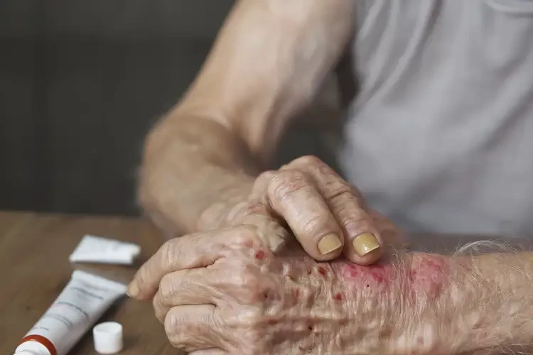 高齡老人手上出濕疹能不能根治(圖4)