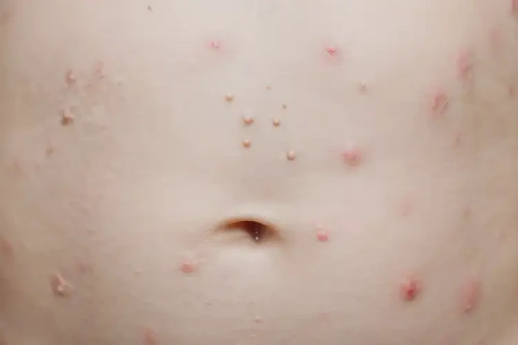 幼兒肚子上長(zhǎng)濕疹能夠徹底治愈嗎(圖4)