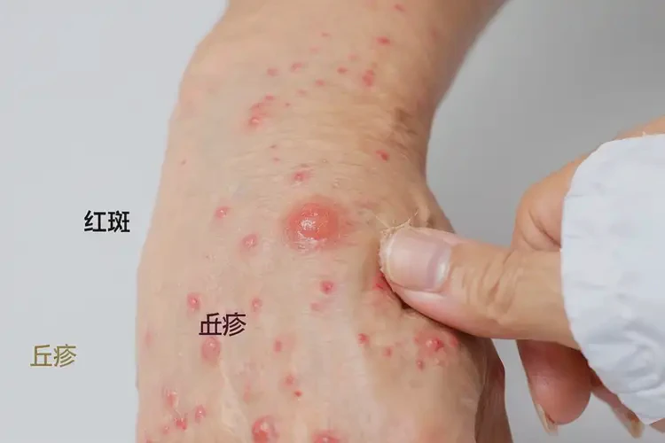 女人手上出濕疹能不能根治(圖4)