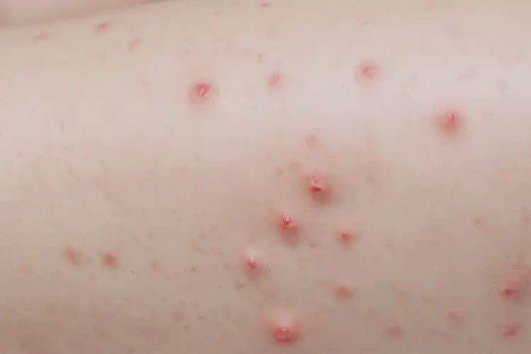 孩子大腿上出現(xiàn)濕疹可不可以徹底自愈(圖4)