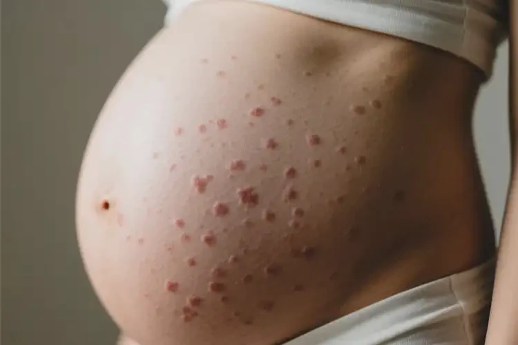 產(chǎn)婦肚子上偶爾長濕疹可不可以根治(圖4)