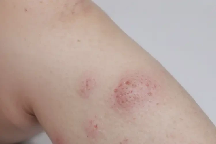 少兒小腿上有濕疹可以徹底自愈嗎(圖3)