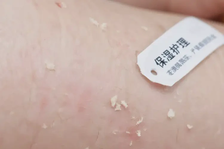 嬰兒手臂容易起濕疹可不可以根治(圖4)