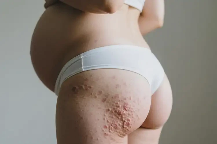 產(chǎn)婦屁股上起濕疹可不可以根治(圖2)