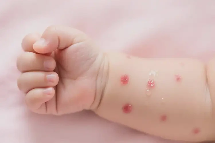 寶寶手臂上有濕疹可不可以根治(圖4)