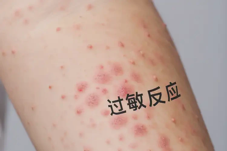 男人手臂上偶爾長濕疹能不能根治(圖4)