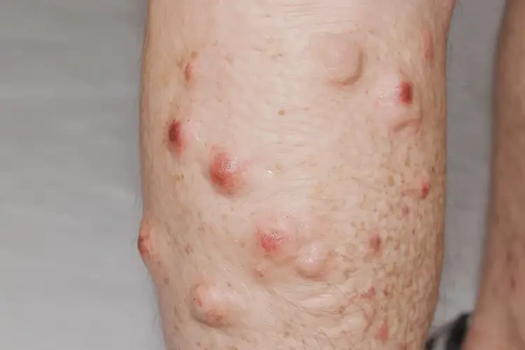 老年人小腿出濕疹能靠自己自愈嗎(圖4)