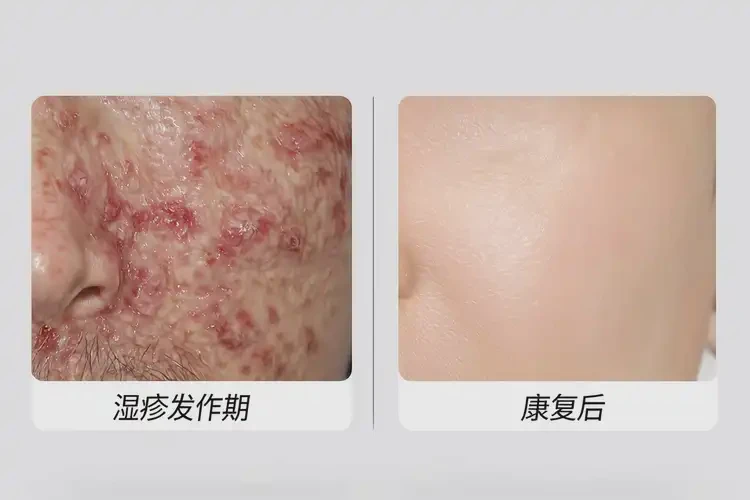 男性身上偶爾起濕疹可不可以徹底自愈(圖2)