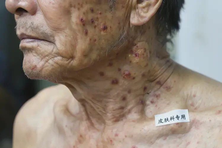 老年人脖子上起濕疹可不可以根治(圖4)
