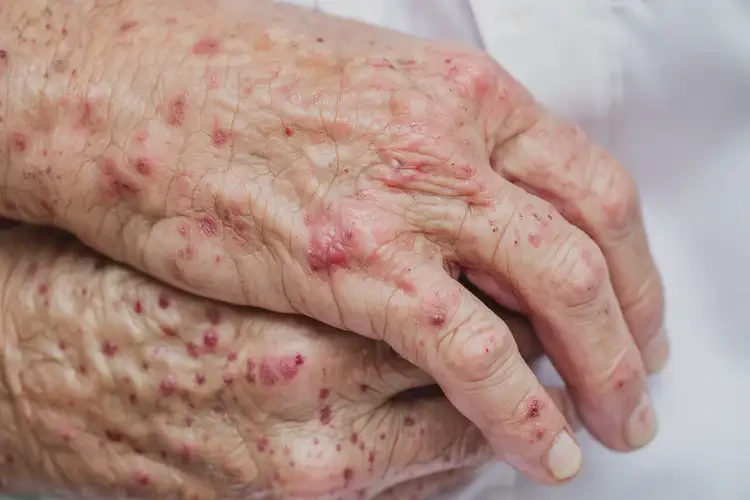 老年人手上出現(xiàn)濕疹可不可以根治(圖4)