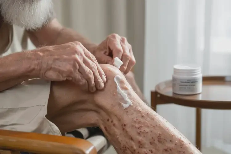 老年人小腿上容易長濕疹可不可以根治(圖3)