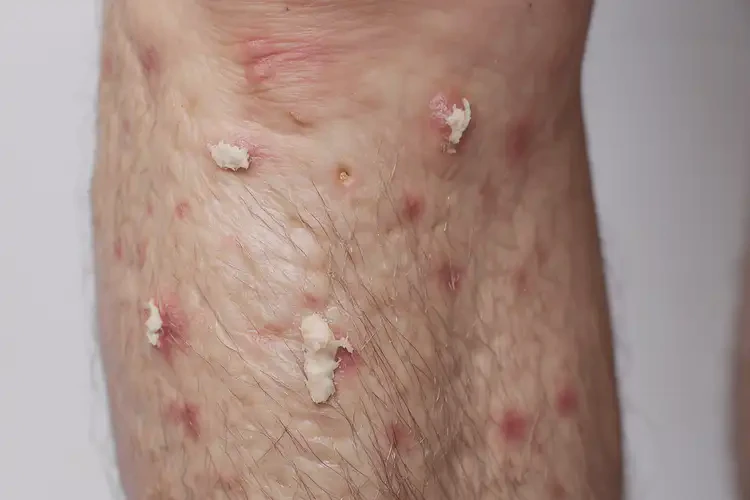 老年人小腿上容易長濕疹可不可以根治(圖4)