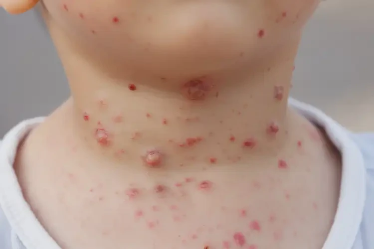 兒童脖子偶爾起濕疹可不可以根治(圖4)