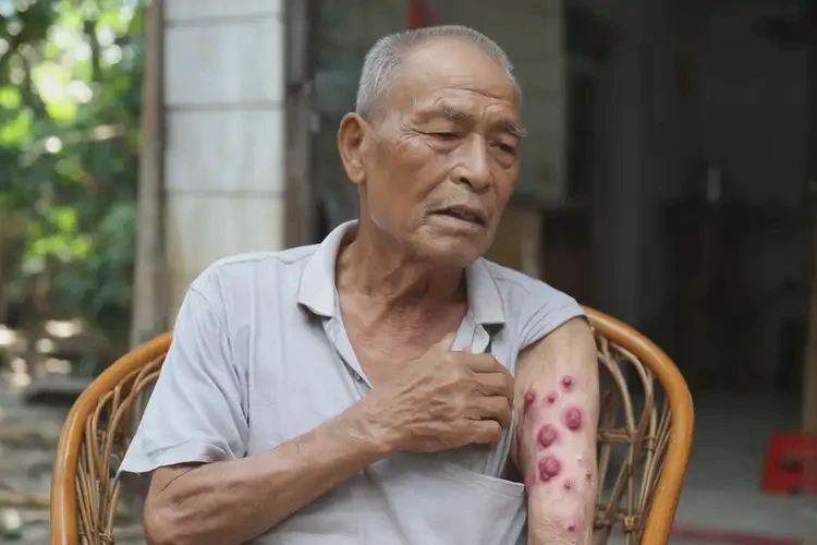 老年人手臂上偶爾長濕疹可不可以根治(圖3)