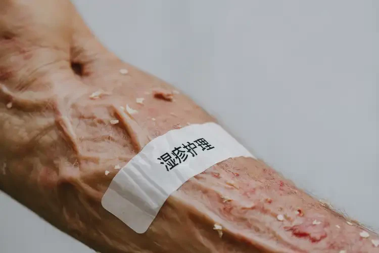 老人身上經(jīng)常起濕疹可不可以根治(圖4)