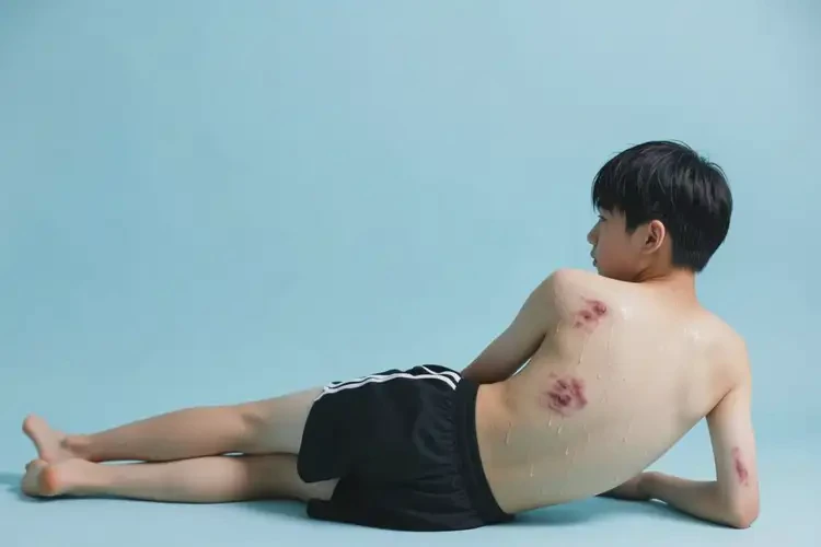 青少年全身出現(xiàn)濕疹可不可以根治(圖2)