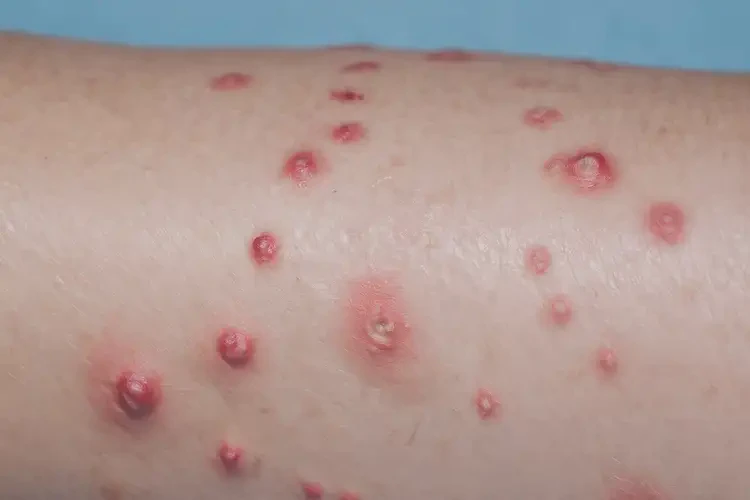 女人大腿上容易起濕疹能不能根治(圖4)