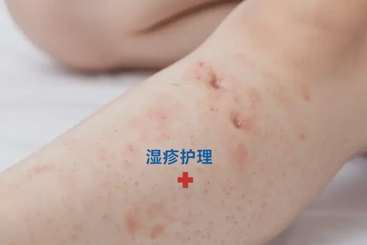 少兒小腿上偶爾長(zhǎng)濕疹能靠自己自愈嗎(圖4)