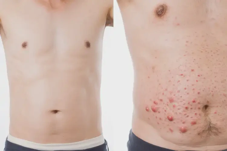 男性肚子上起濕疹可不可以根治(圖1)