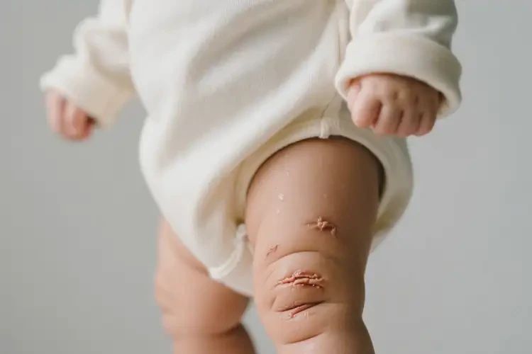 婴儿小腿长湿疹可不可以根治(图2)