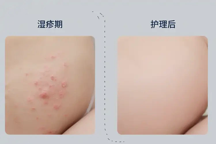 寶寶屁股偶爾起濕疹能靠自己自愈嗎(圖2)