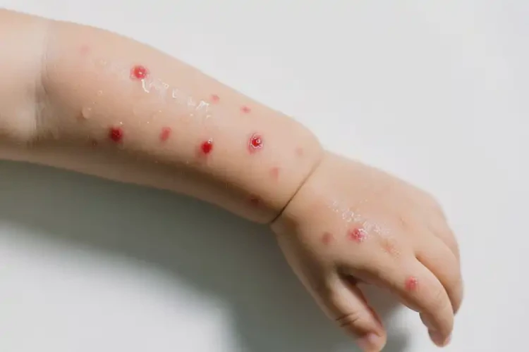 幼兒手臂上有濕疹可不可以根治(圖2)