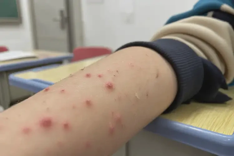 小學(xué)生手臂長(zhǎng)濕疹可不可以根治(圖4)