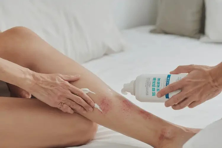 哺乳期妈妈小腿上经常长湿疹能不能根治(图3)