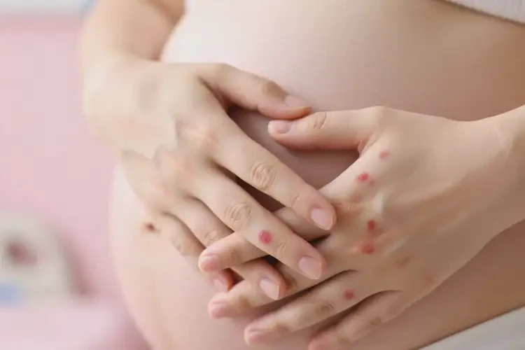 孕婦手上偶爾起濕疹能徹底自愈嗎(圖1)