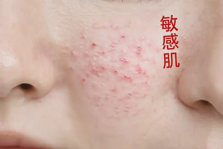 女性屁股上偶爾長濕疹可不可以根治(圖4)