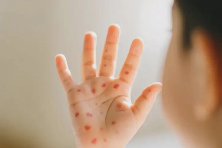 小孩手上經(jīng)常起濕疹可以治好嗎(圖4)