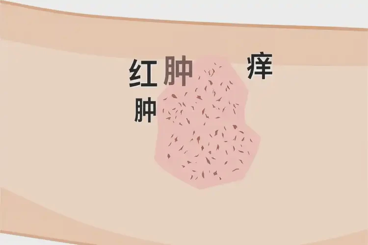 男性手臂容易长湿疹可不可以根治(图4)