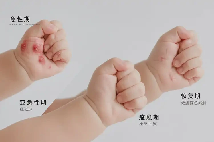 少兒手上經(jīng)常起濕疹可不可以徹底自愈(圖4)
