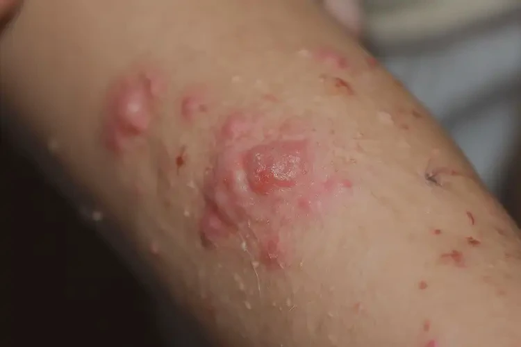 兒童手臂上長濕疹可不可以根治(圖4)