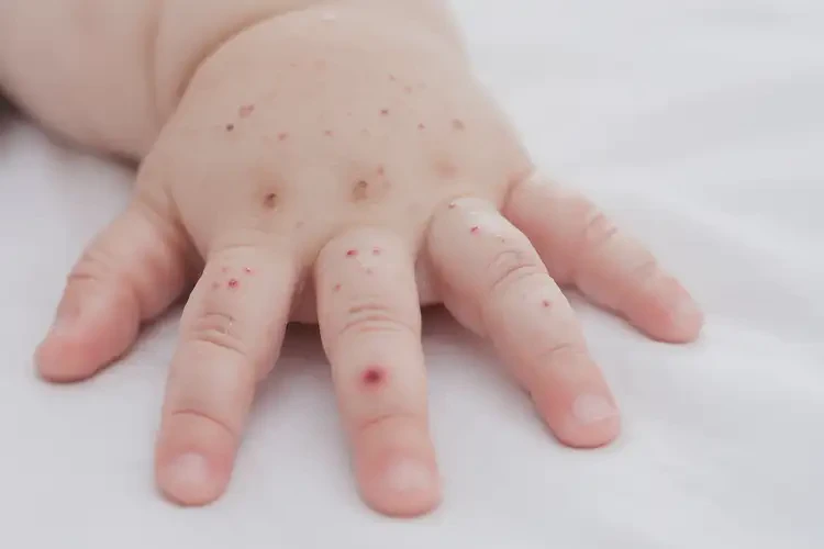 宝宝手上经常起湿疹可以治好吗(图4)