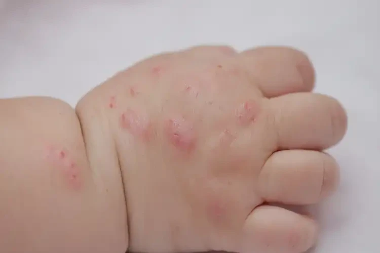 婴幼儿手上长湿疹不管它会自己痊愈吗(图4)