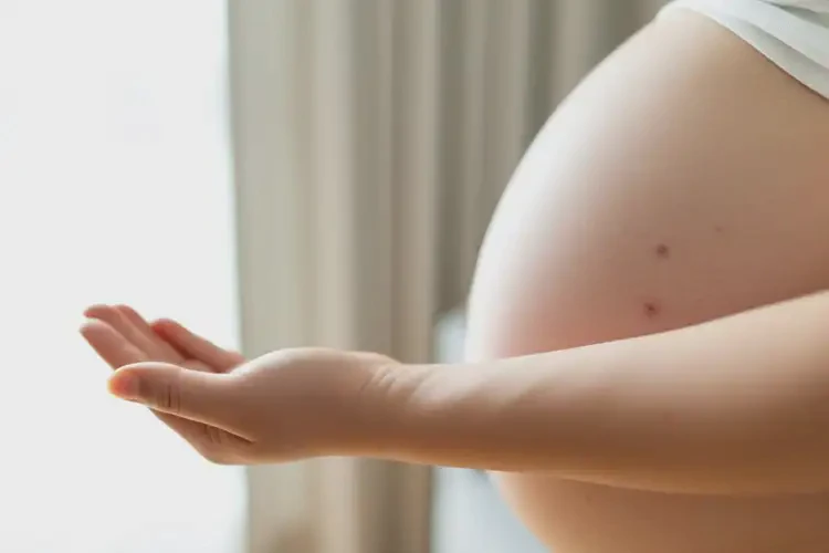 孕妇手臂上起湿疹可不可以根治(图4)