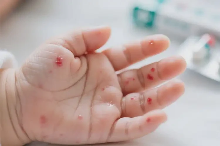 新生儿手上偶尔长湿疹可不可以根治(图2)