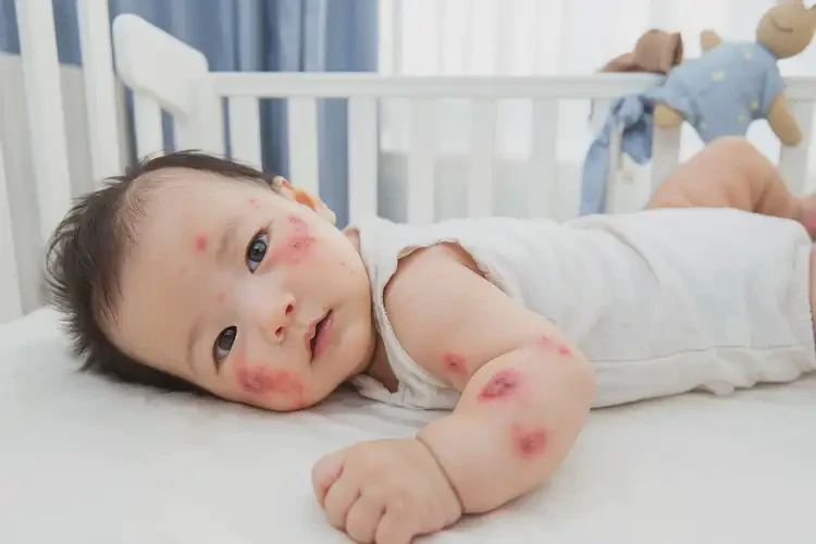 小兒屁股有濕疹可不可以根治(圖4)