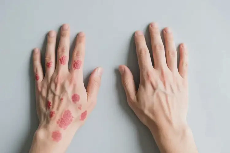 男性手上有湿疹可不可以根治(图2)