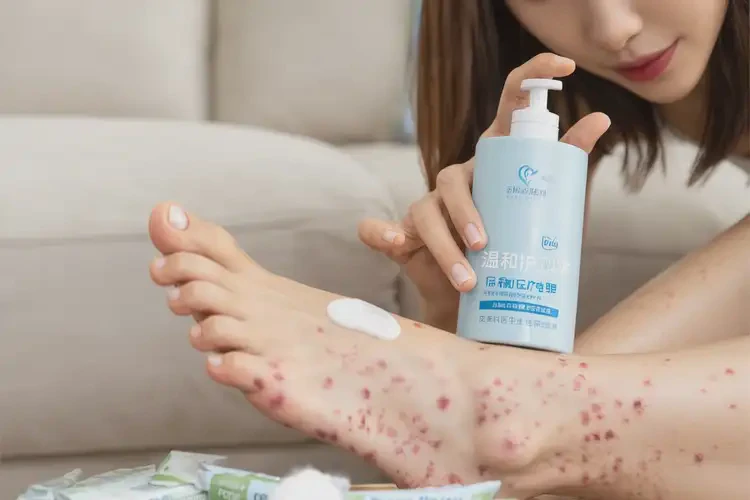 女生腳上有濕疹可不可以根治(圖4)