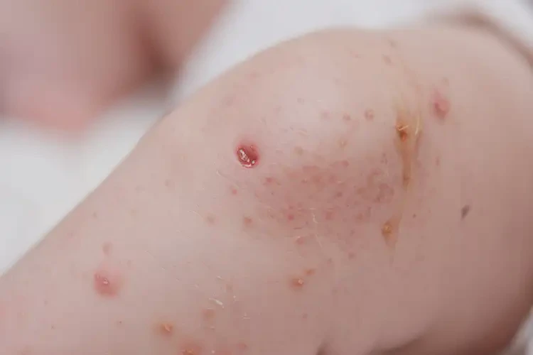 新生兒小腿上經(jīng)常起濕疹可不可以根治(圖4)