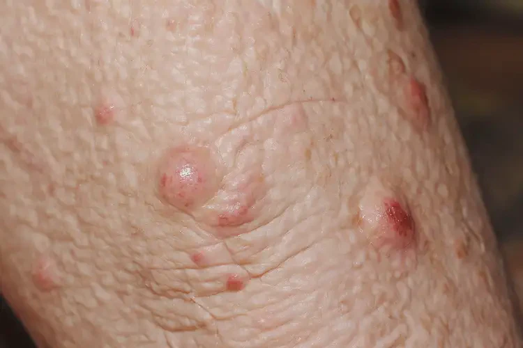 老人小腿上起濕疹可不可以根治(圖4)