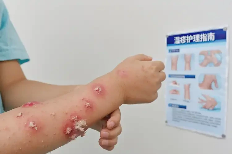 兒童身上容易長(zhǎng)濕疹不管它會(huì)自己痊愈嗎(圖3)