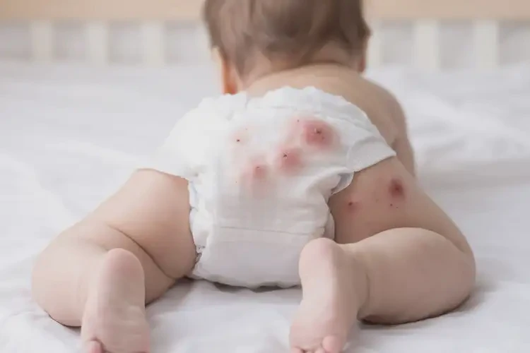 兒童屁股起濕疹可不可以根治(圖4)