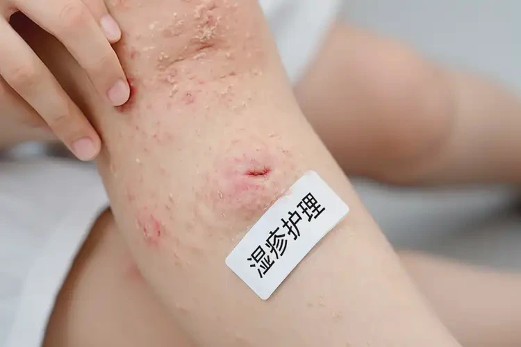 小孩大腿上容易长湿疹能够彻底治愈吗(图3)