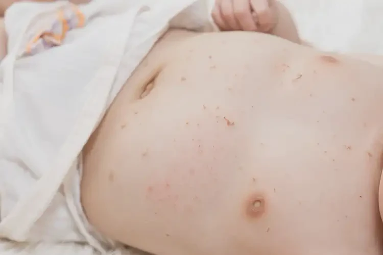 寶寶肚子經(jīng)常長(zhǎng)濕疹可以徹底自愈嗎(圖3)