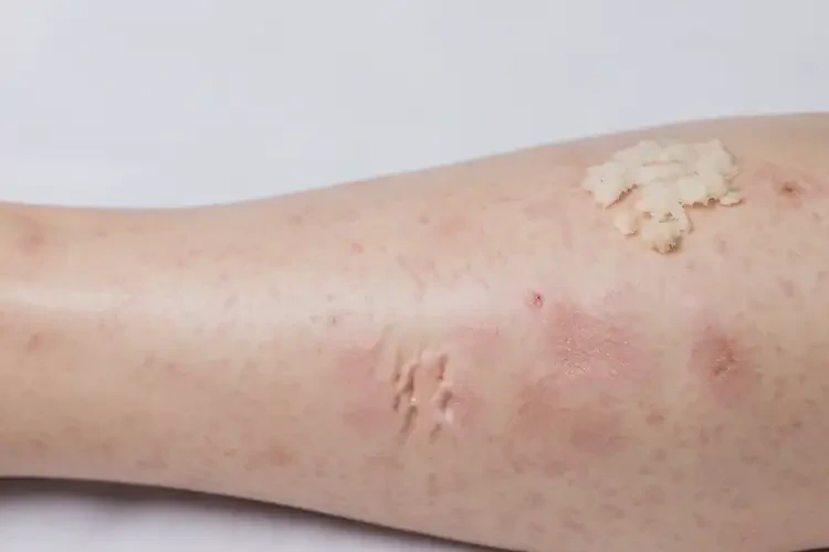 女生小腿上出現(xiàn)濕疹可以徹底自愈嗎(圖3)