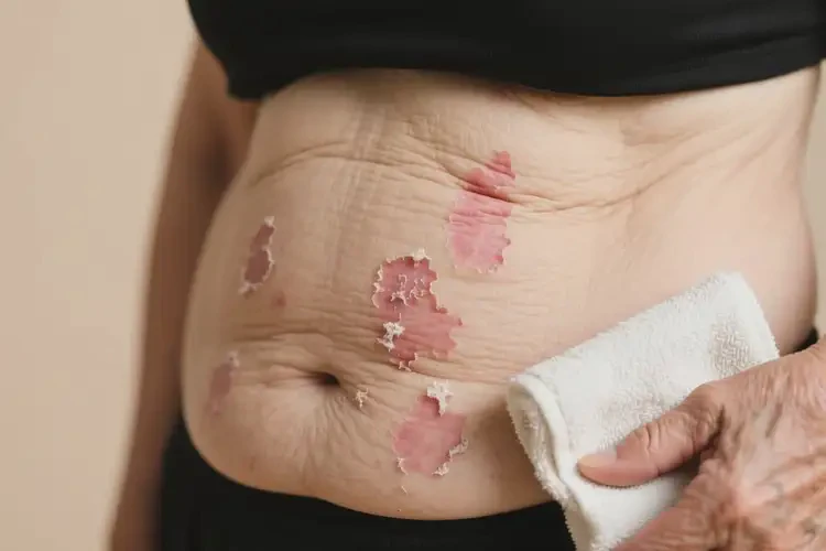 老年人肚子出現(xiàn)濕疹可不可以根治(圖3)