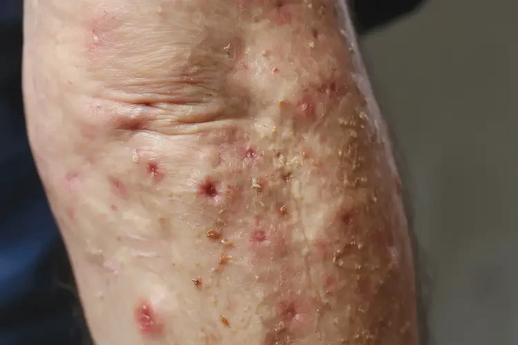 老人手臂長(zhǎng)濕疹可不可以根治(圖4)